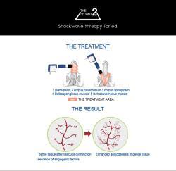 Аппарат для ударно-волновой терапии стопы ABS для снятия боли (арт. 25-19081830)