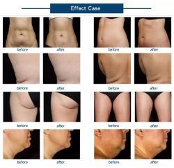 Машина для коррекции фигуры с роликом против целлюлита ABS (арт. 25-19081912)